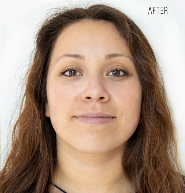 After Treatment