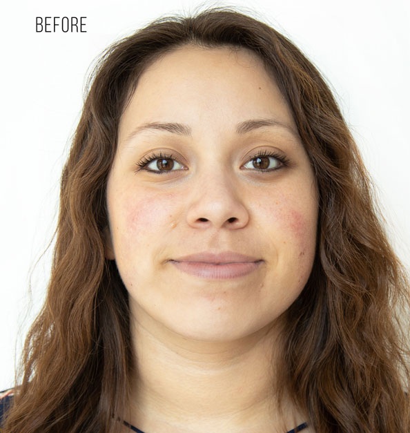 Before Treatment