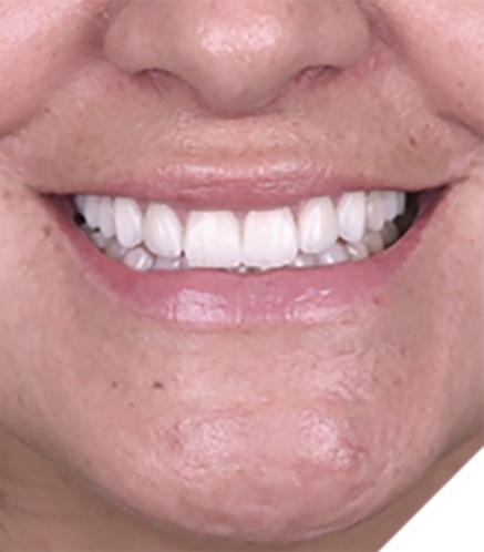 After Treatment