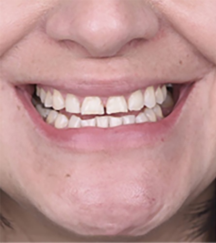 Before Treatment