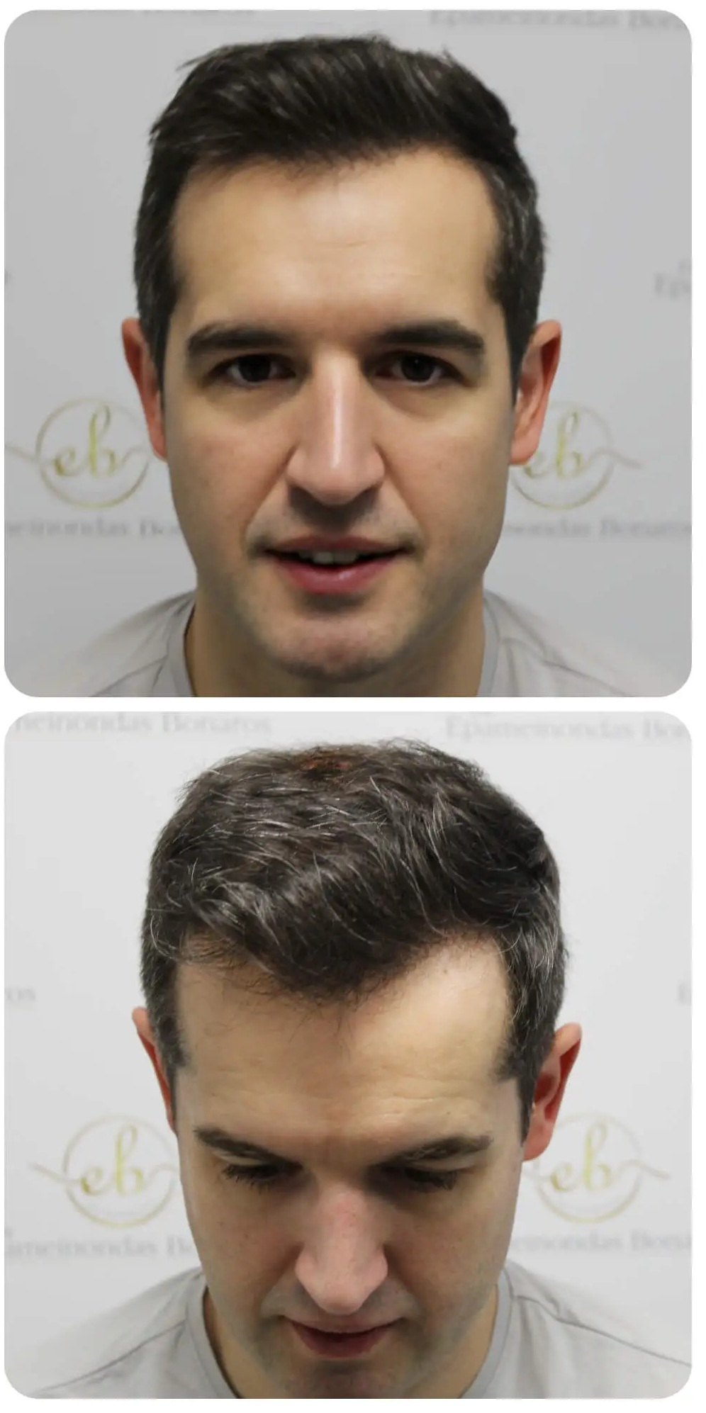 After Treatment