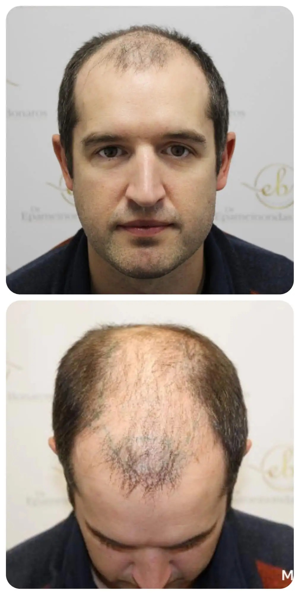 Before Treatment