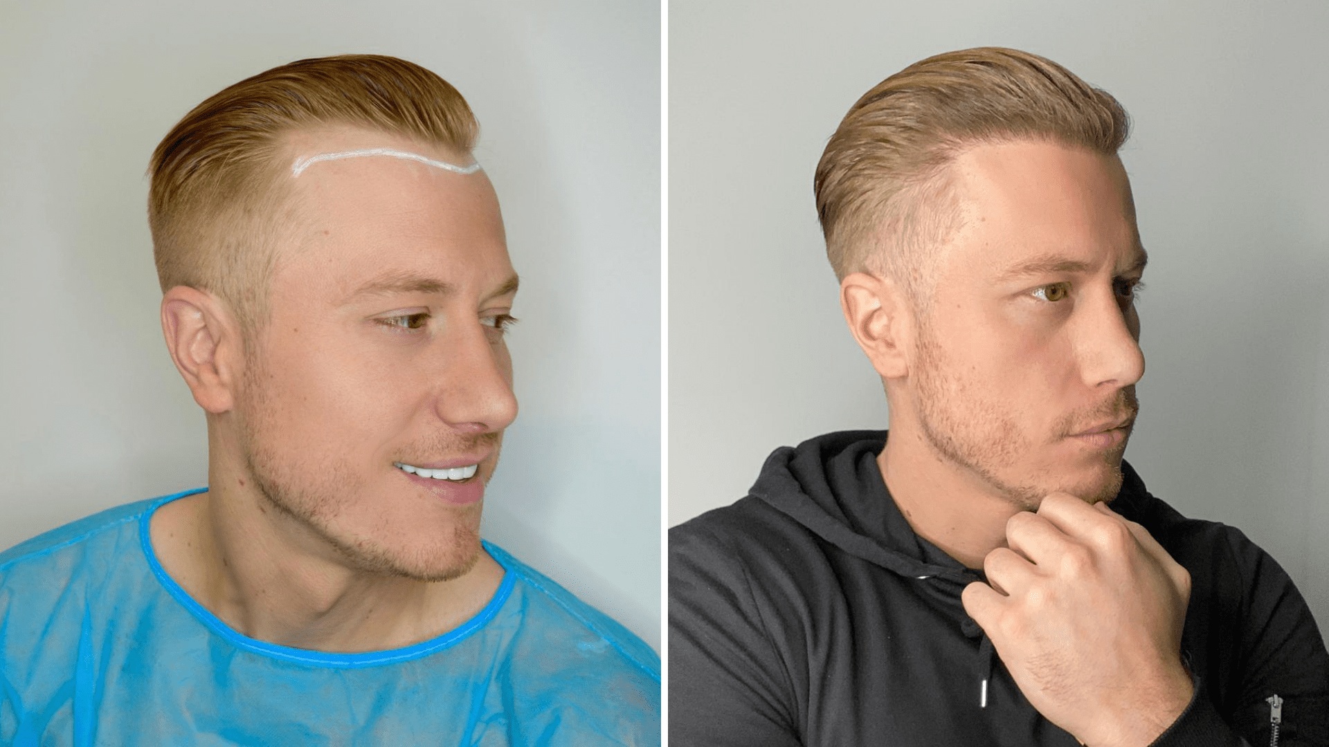 Hair Transplant